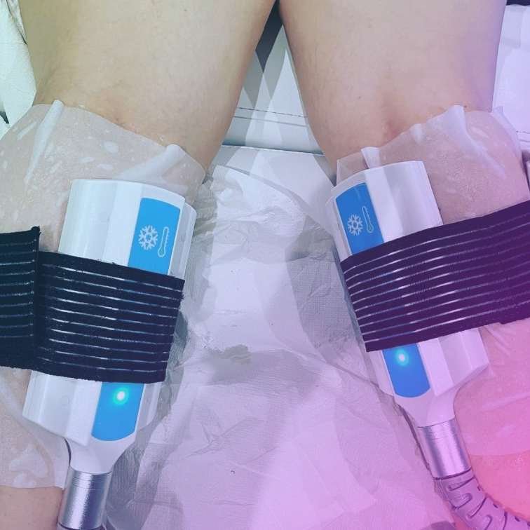 Cryo slimming 3