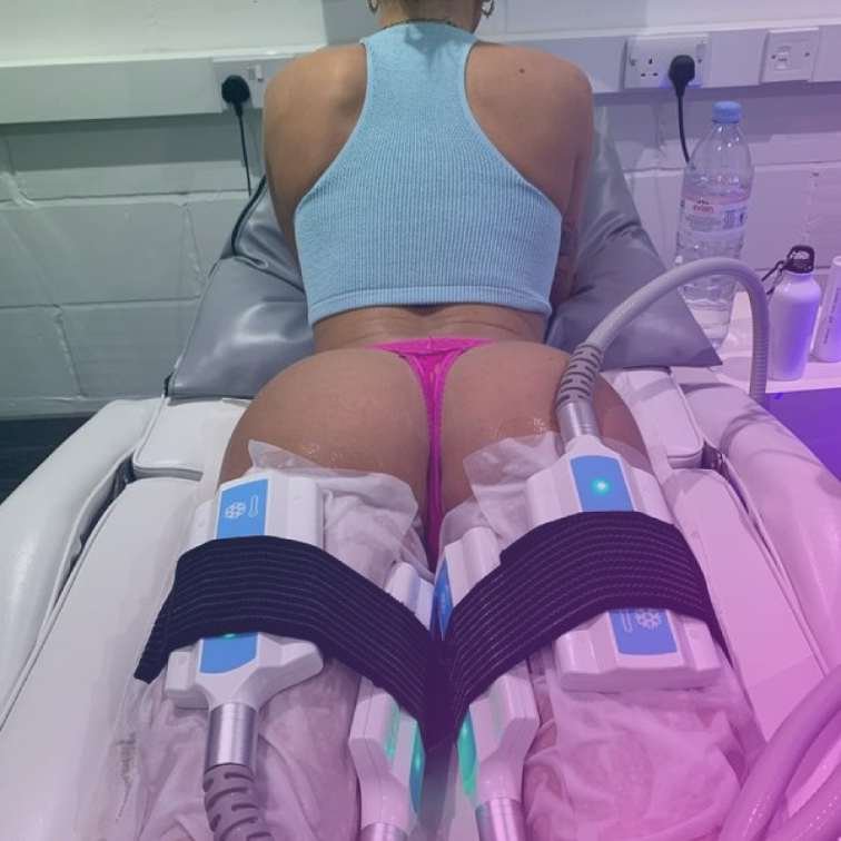 Body contouring cryo slimming